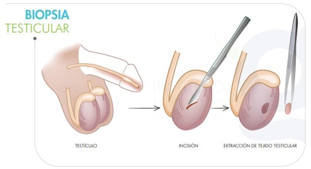 biopsia-testicular-para-detectar-el-origen-de-la-infertilidad-masculina-ilustracion-de-como-se-lleva-a-cabo-una-biopsia-testicular
