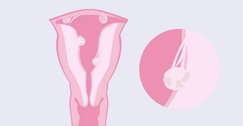pelvic-adhesions