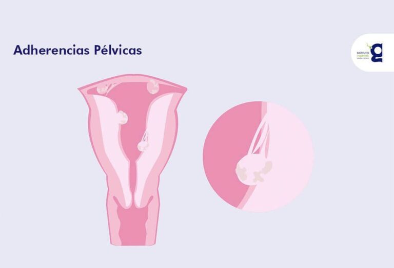 adherencias-pelvicas-como-afectan-mi-fertilidad-infografia